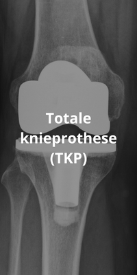 Totale knieprothese TKP röntgen foto
